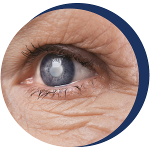 Cataract Doctor Near Me