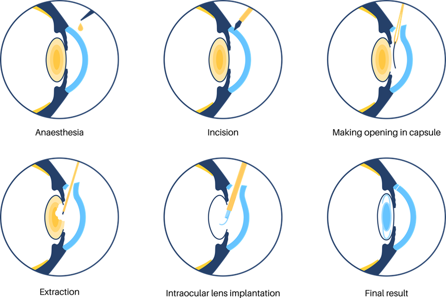 Cataract Surgery Eye Care Specialists of Michigan