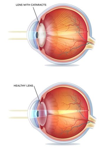 Cataract Treatment Cataract Treatment