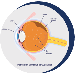 Eye Floaters and Flashers