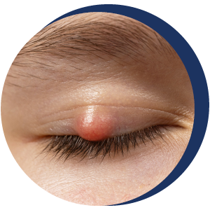 Stye Removal Eye Care Specialists of Michigan