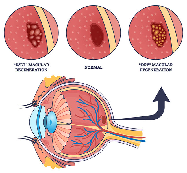 Wet and Dry Macular Degeneration